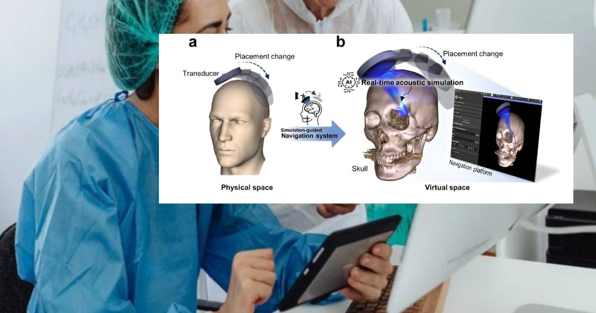 Artificial intelligence lowers barrier to ultrasonic brain treatment